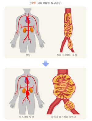 복부대동맥류는 동맥경화 등이 원인이 되어, 복부의 가장 큰 혈관인 대동맥이 풍선처럼 부푸는 질병이다. 	그림=대한의학회