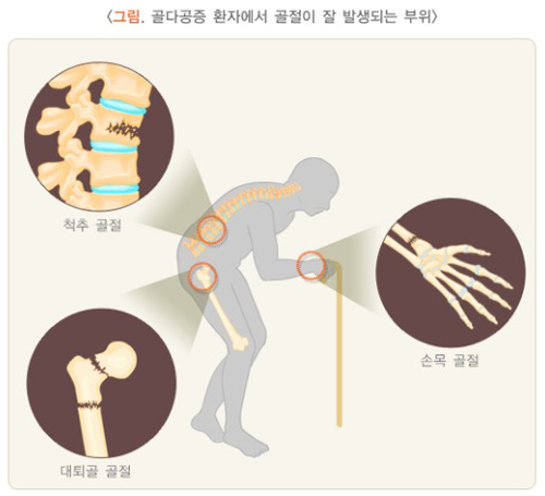 골다공증으로 인해 뼈가 부러지기 쉬운 부분은 손목, 척추(허리 뼈), 대퇴골(넓적다리뼈)이다. 뼈의 밀도가 낮아지면, 조직이 헐거워져 작은 충격에도 쉽게 골절을 당할 수 있다.