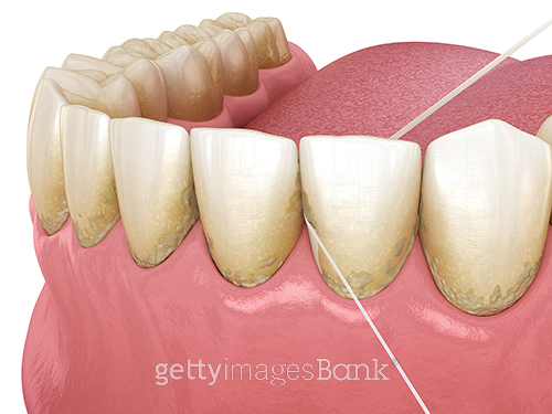 치실을 올바로 사용하면 치아 사이의 이물질뿐 아니라 플라크와 결합하는 치태를 제거해 치석의 발생을 억제하는 데 도움을 준다.