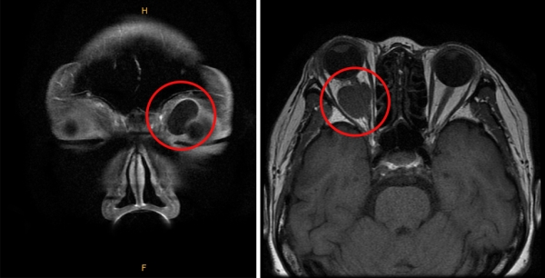 안와 앞쪽에 생긴 낭성 종괴(왼쪽)와 안와 뒤쪽에 생긴 시신경종양(오른쪽).