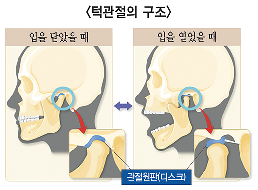 턱관절은 아래턱뼈와 머리뼈 그 사이의 관절원판이 있고, 인대와 근육이 그 주변을 둘러쌓는 구조이다. 턱관절 장애는 이러한 턱관절에 염증이 생기거나 아래턱 뼈 구조물중 하나인 하악과두의 탈구 등으로 인해 통증이 생기는 증상을 말한다. 	그림=보건복지부, 대한치의학회