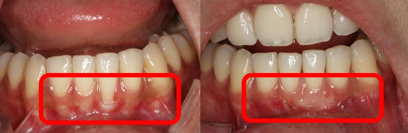 잇몸이식술을 통해 노출된 치근면을 덮기 전(왼쪽)과 치료 후 모습(오른쪽).