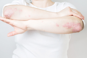 피부에 두꺼운 각질 일으키는 자가면역질환 건선의 증상과 치료법