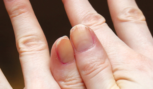 손·발톱으로 확인하는 나의 건강상태…금 가거나 깨지면 비타민·단백질 부족 신호