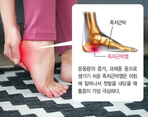 걷기만 해도 발바닥이 찌릿찌릿한 ‘족저근막염’의 증상과 치료