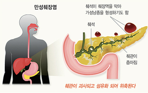 심한 복통 유발하는 췌장염… 방치 땐 ‘암’ 발병 위험
