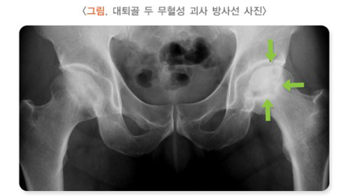 ‘대퇴골 두 무형성 괴사’로 의심되는 환자의 방사선 사진. 좌측 대퇴골 두에 음영변화(화살표)가 뚜렷하고 상부가 약간 함몰되어 평편해진(화살촉) 모습이 보인다. 	그림=대한의학회