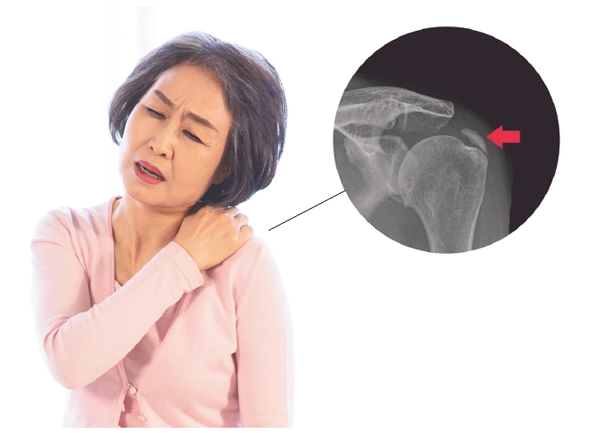 석회성 건염은 어깨 힘줄 조직에 석회가 침착되고, 이 때문에 통증이 발생되는 질환이다. 오른쪽 위의 사진은 힘줄 조직에 석회가 발견된 X레이 사진이다.