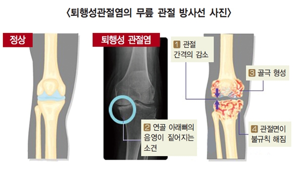 무릎 퇴행성관절염은 증상에 따라 치료를 달리해야 합니다.