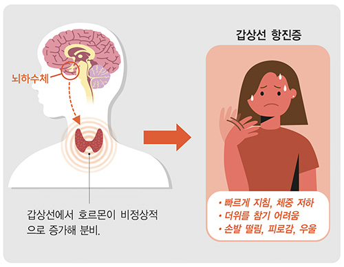 박신양씨가 앓고 있다는 갑상선 기능 항진증의 주요 원인, 치료방법, 그레이브스병 정보