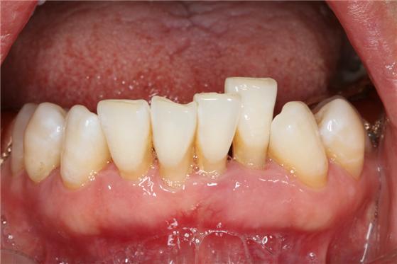 치주질환 및 정출로 인해 잇몸이 퇴축되고 치아 뿌리가 상당 부분 노출된 환자의 모습.