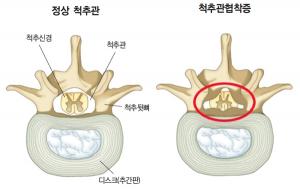 허리 구부릴 때 통증 사라지면 ‘척추관협착증’ 의심