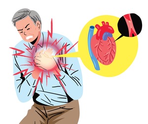 기온 떨어지면 혈관 수축돼 ‘심근경색증’ 위험 증가