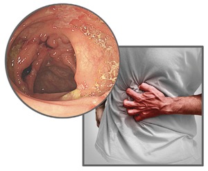 염증성 장질환 ‘크론병’… ‘무증상 유지’가 치료의 목표